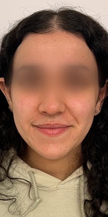 Before treatment